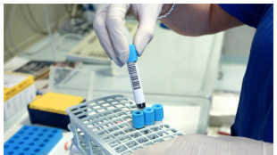 La gravità dell'Alzheimer stimata da un semplice test del sangue