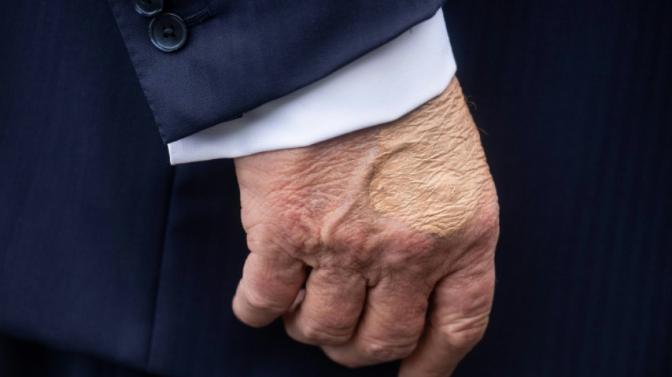 Trump diagnosed with vein issue after leg swelling and hand bruising