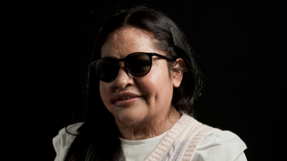 S'aider pour gu&eacute;rir, la devise des Mexicaines victimes d'attaques &agrave; l'acide
